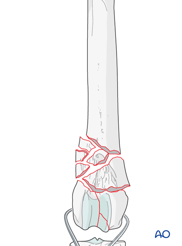 The articular fracture of the condyles is reduced with pointed reduction forceps