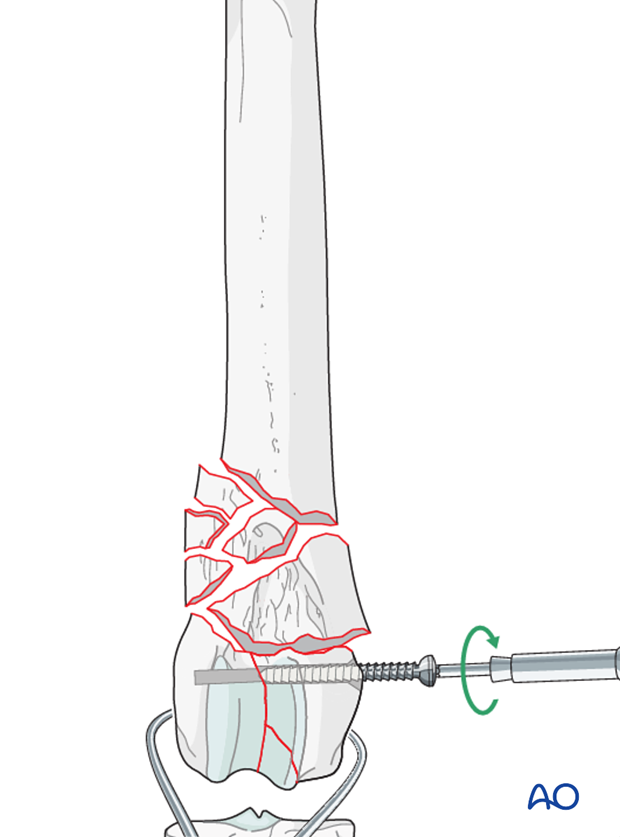 Stabilization is achieved with inserting a lag screw across the condyles perpendicular to the fracture plane