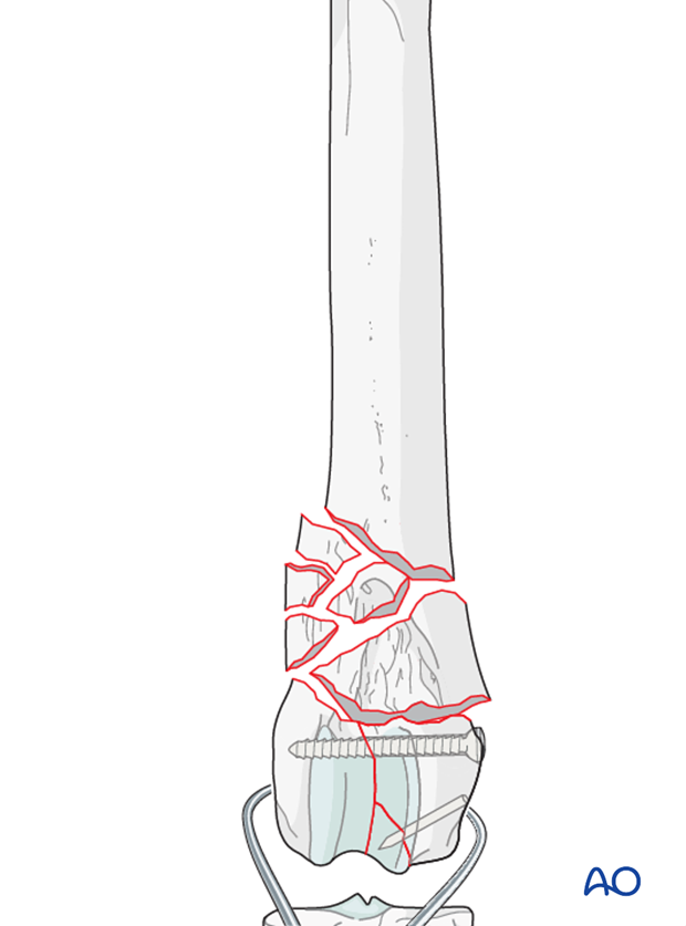 Definitive stabilization of the smaller fragments of the condyles may be performed using lag screws or K-wires