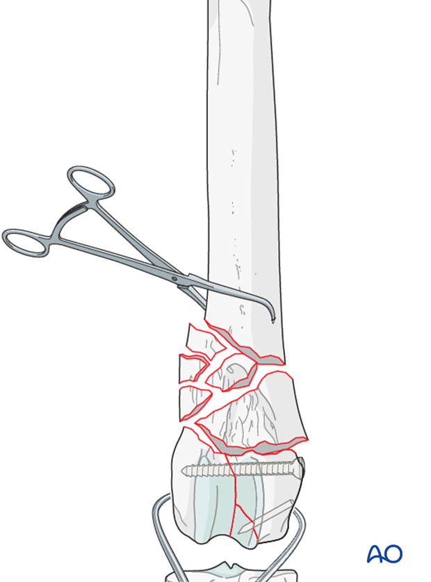 Bone holding forceps are applied to the proximal and distal major fragments for distraction