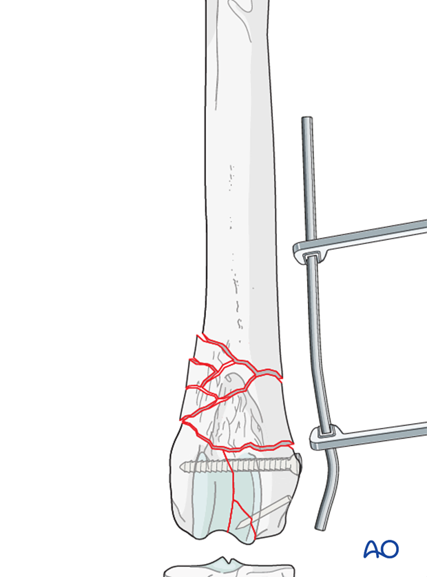 The plate is contoured to the lateral aspect of the distal femur