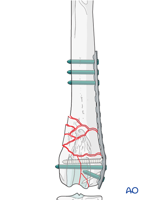 If a locking plate is used, only 2-3 locking bicortical screws are needed per main fragment