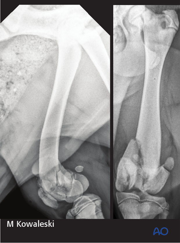 Radiograph of a 5-month-old Labrador retriever with a 33-C3 fracture, a transverse fracture of the patella, and 31-B2 fracture.