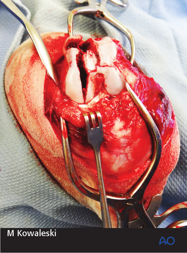 Intraoperative photograph demonstrating visualization of the articular fractures through a lateral parapatellar approach.