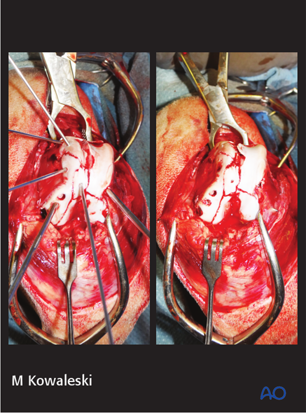Intraoperative photographs demonstrating reduction and stabilization of the articular fractures through a lateral parapatellar approach.