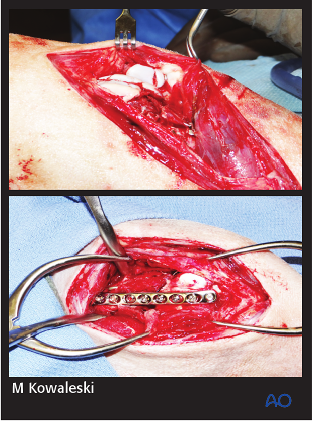Intraoperative photographs demonstrating reduction and stabilization of the patellar fracture and distal femoral fracture through a medial parapatellar approach.
