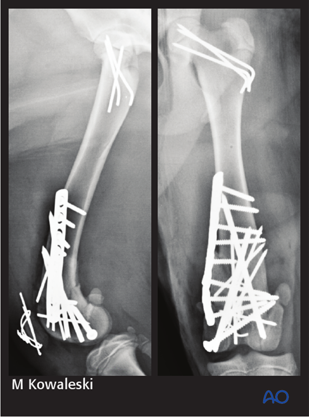 Immediate postoperative radiograph of a dog with a 33-C3 fracture repaired using cross pins, screws and a bridging plate.