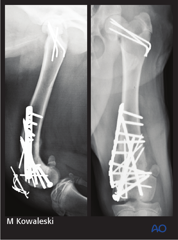 transcondylar lag screw and bridging plate