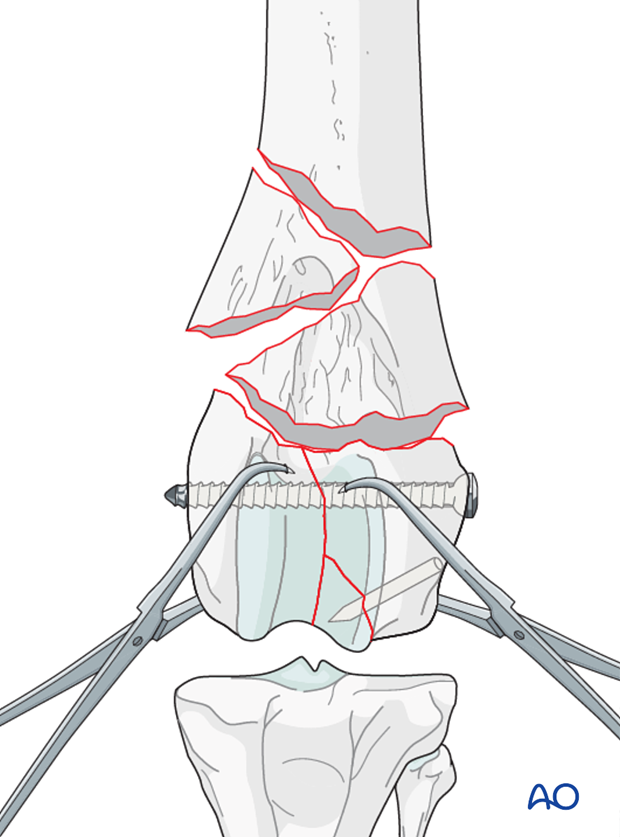 If the lag screw is not placed perpendicular to the fracture plane, this will result in loss of anatomic reduction of the articular surface