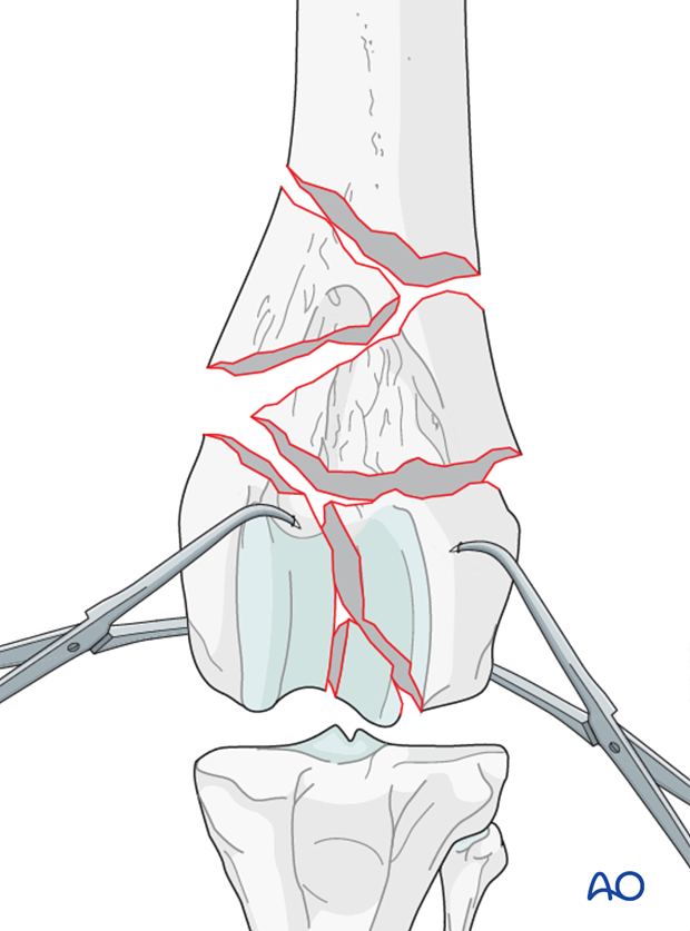 The articular fracture of the condyles is reduced with pointed reduction forceps