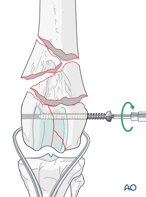 Stabilization is achieved with inserting a screw in lag fashion across the condyles perpendicular to the fracture plane