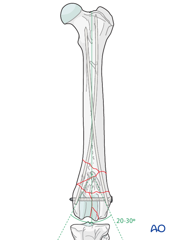 Cross pinning and transcondylar lag screw fixation in a type C1 fracture in a distal femur of a dog