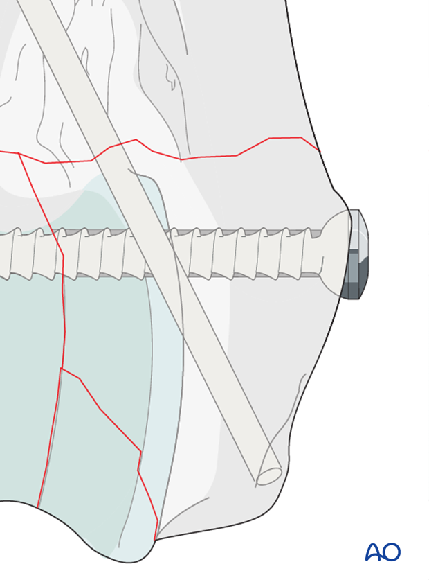 The pins can be cut flat with the bone surface or bent over and then cut short