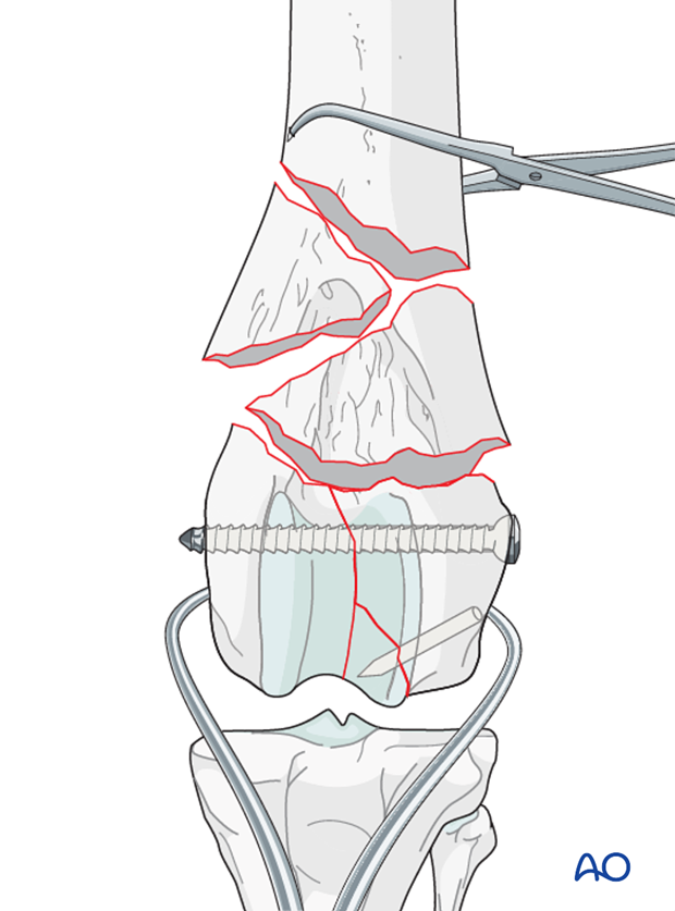 The reconstructed femoral condyles are carefully reduced to the metaphysis with pointed reduction forceps