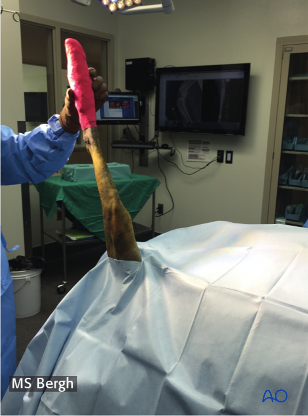 D33_PO10_i100 Sterile wrap