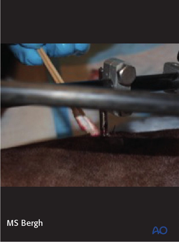 external skeletal fixator