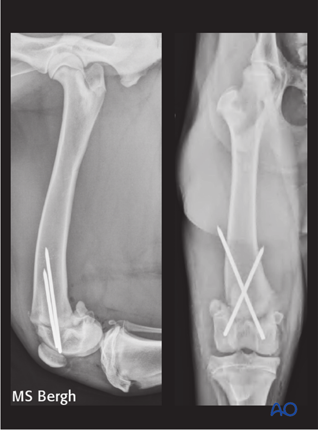 D33_X10_i020 complications in distal femoral fractures