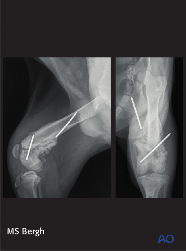 D33_X10_i040 complications in distal femoral fractures