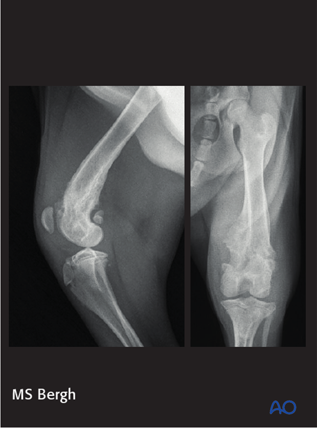 D33_X10_i060 complications in distal femoral fractures