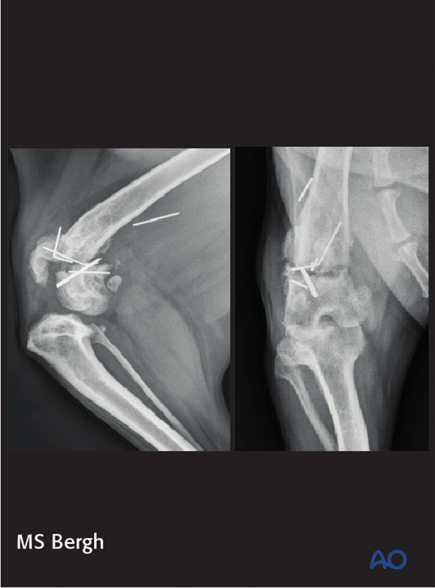 complications in distal femoral fractures
