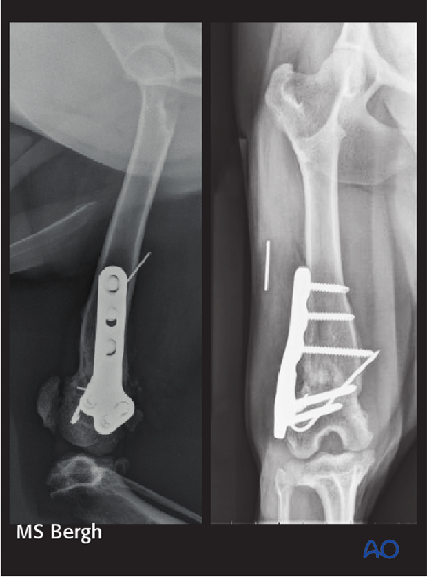 D33_X10_i100 complications in distal femoral fractures