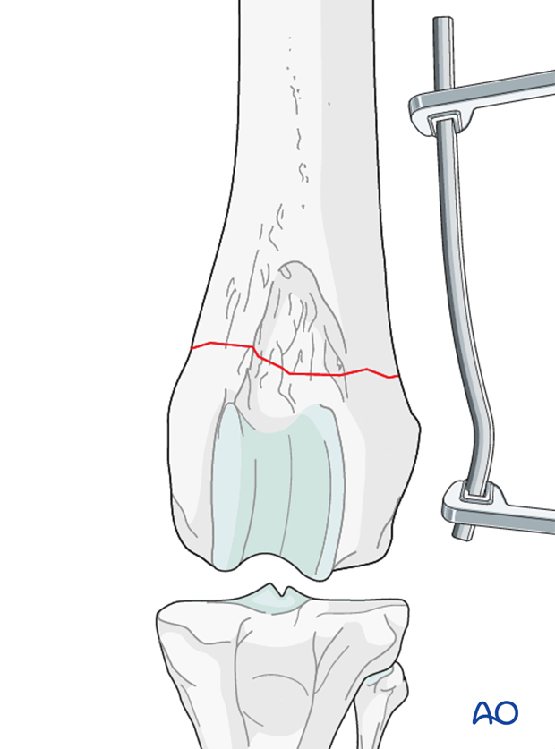 plate preparation