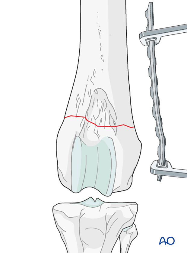 plate preparation