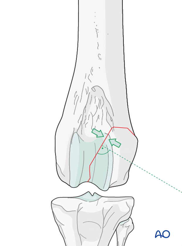 lag screw fixation