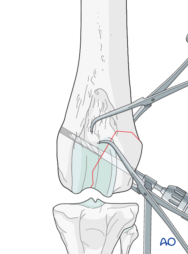 lag screw fixation