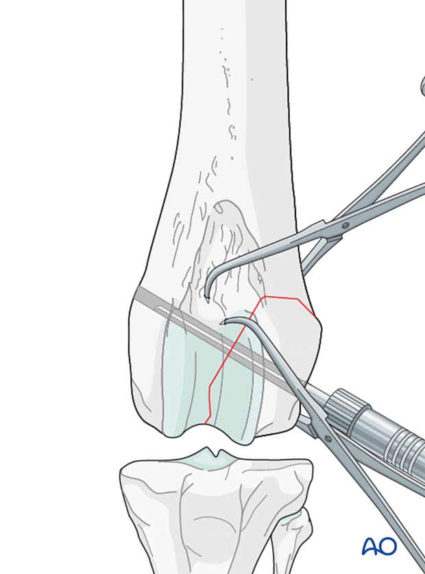 lag screw fixation
