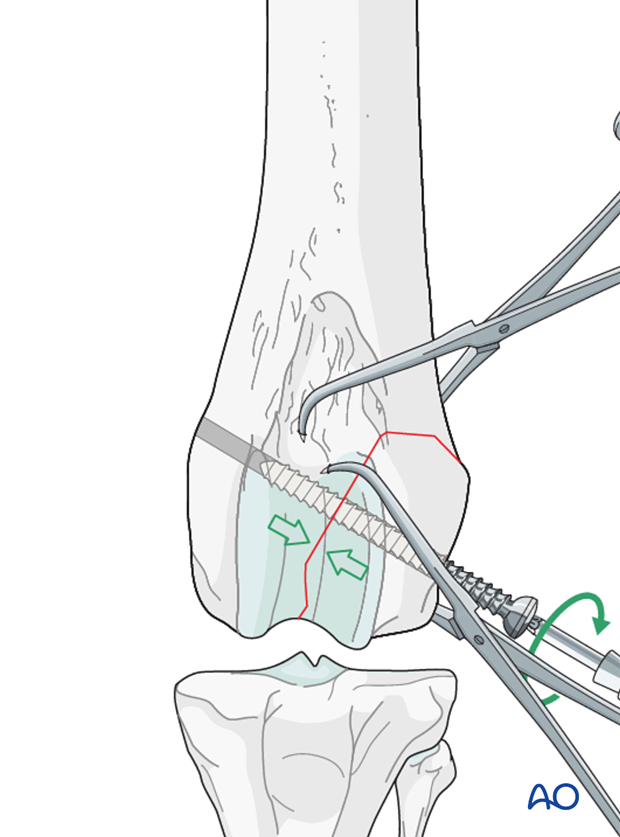 lag screw fixation
