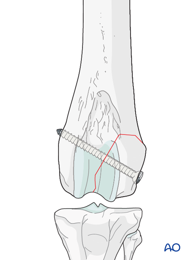 lag screw fixation