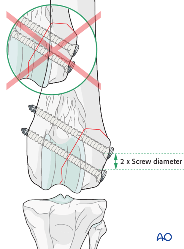 lag screw fixation