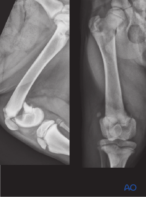 D33_X50_i020 physeal fractures