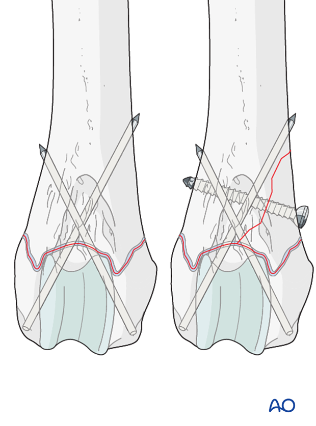 D33_X50_i060 physeal fractures