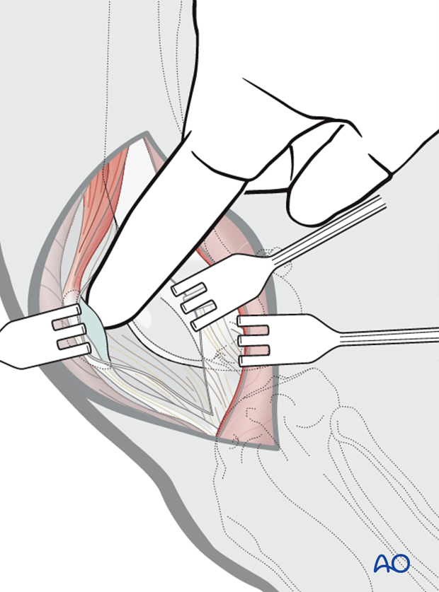 Patellar surface exposure and inspection