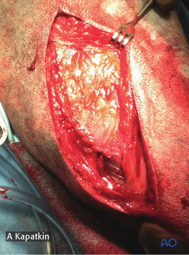 Closure of lateral parapatellar approach