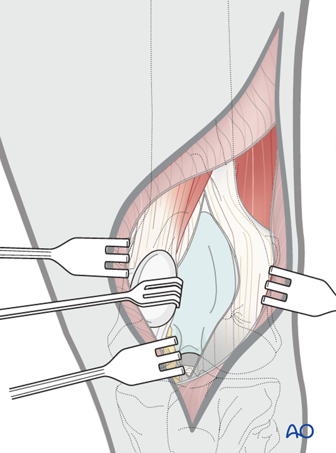 Lateral parapatellar approach to the cat patella