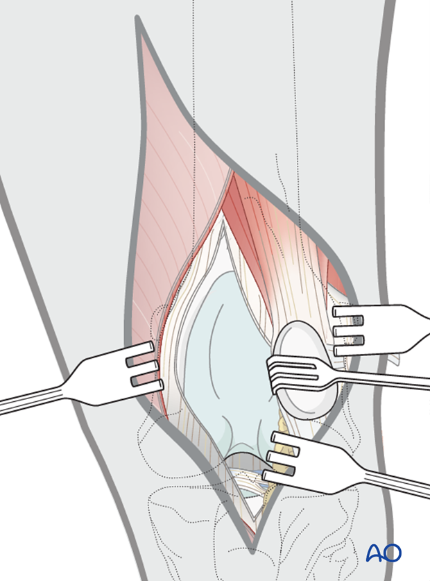 Medial parapatellar approach