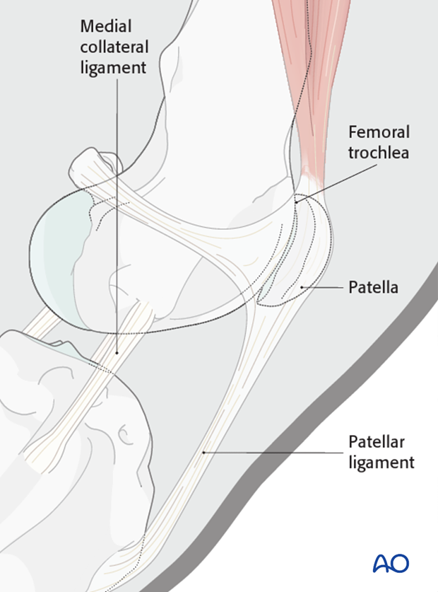 Anatomic landmarks for medial parapatellar approach