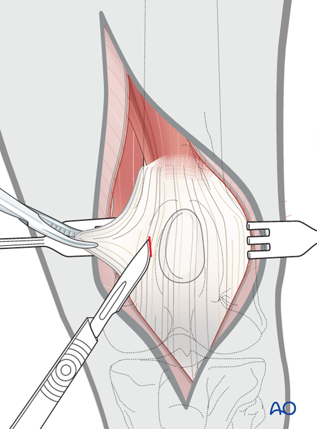 Stab incision