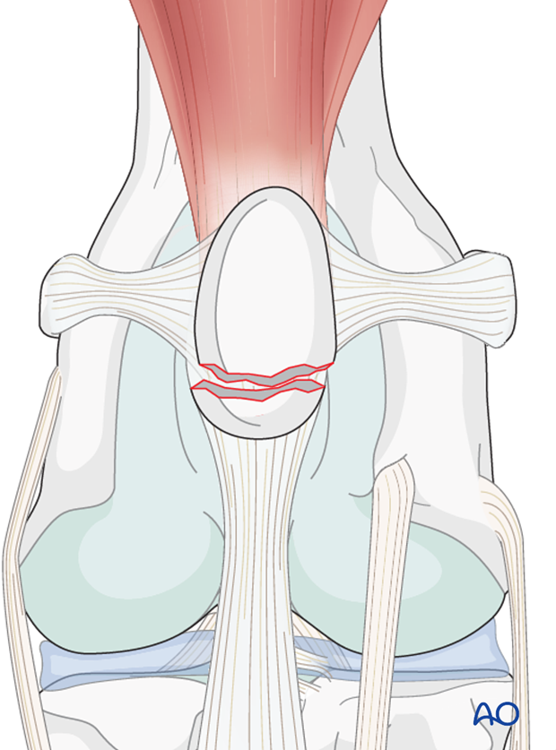 Patellar avulsion fracture in a dog