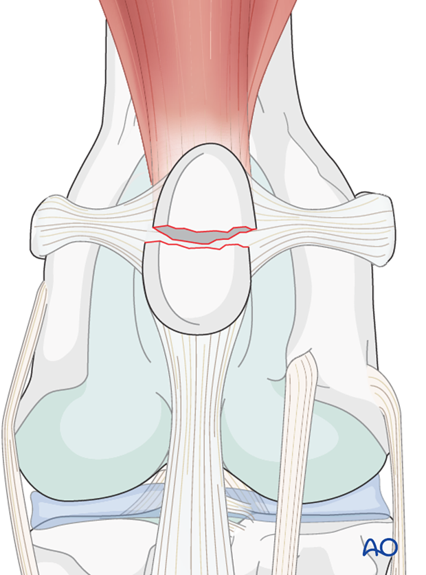 Transverse patellar fracture in a dog