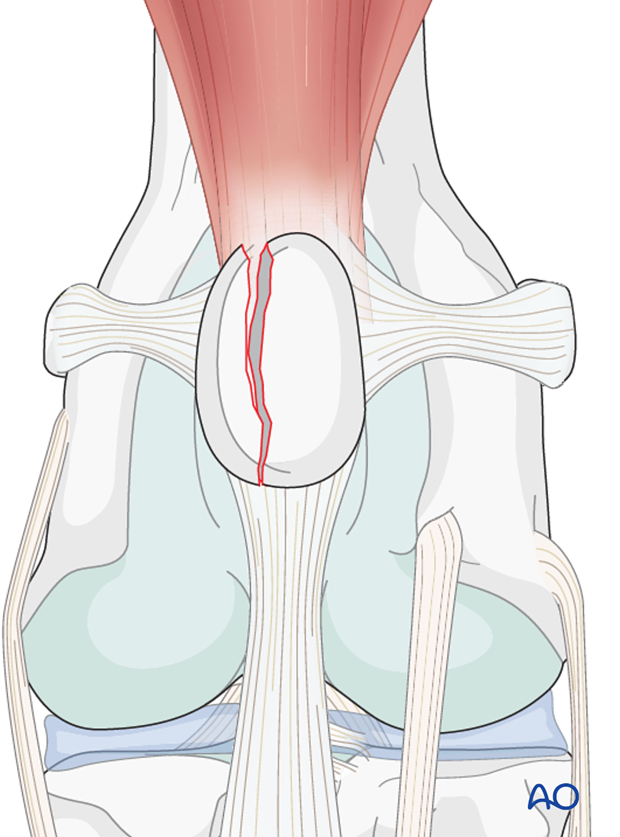 Longitudinal patellar fracture in a dog