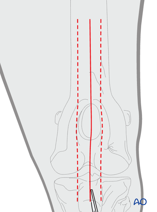 Sagittal or parasagittal skin incision