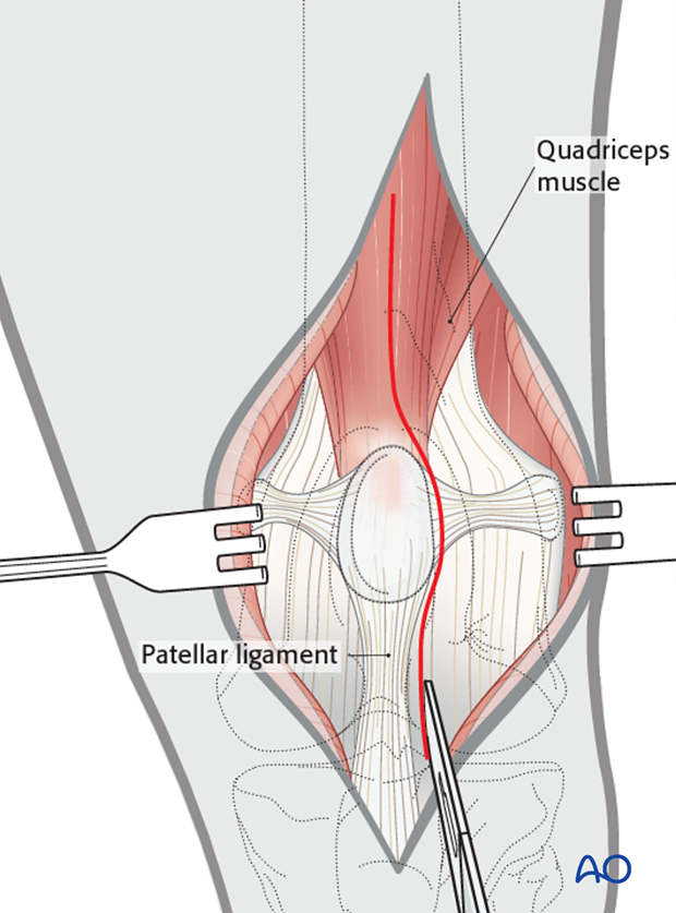 Lateral parapatellar dissection