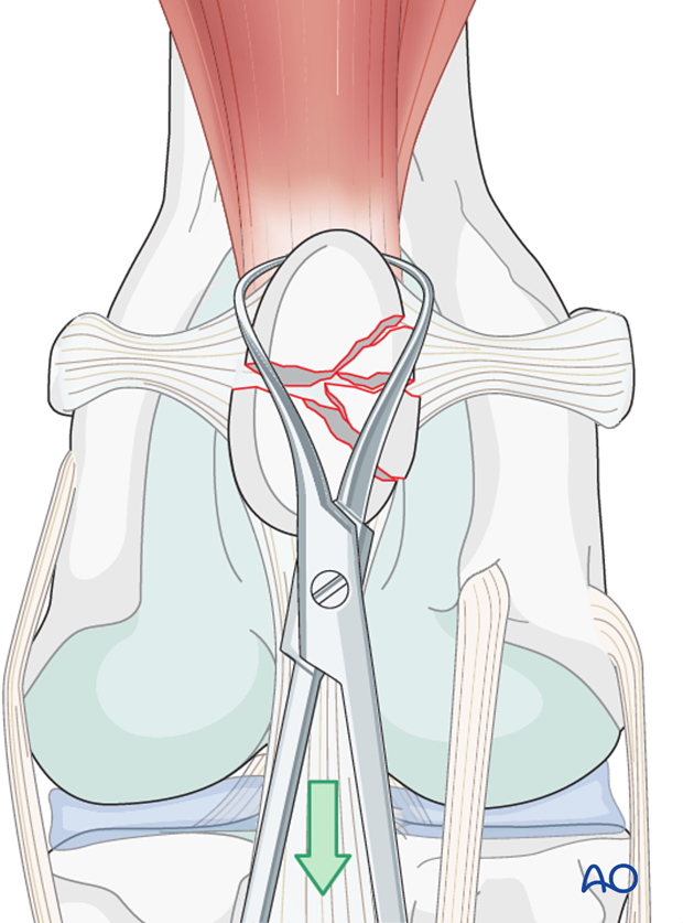 Reduction of patella fragments