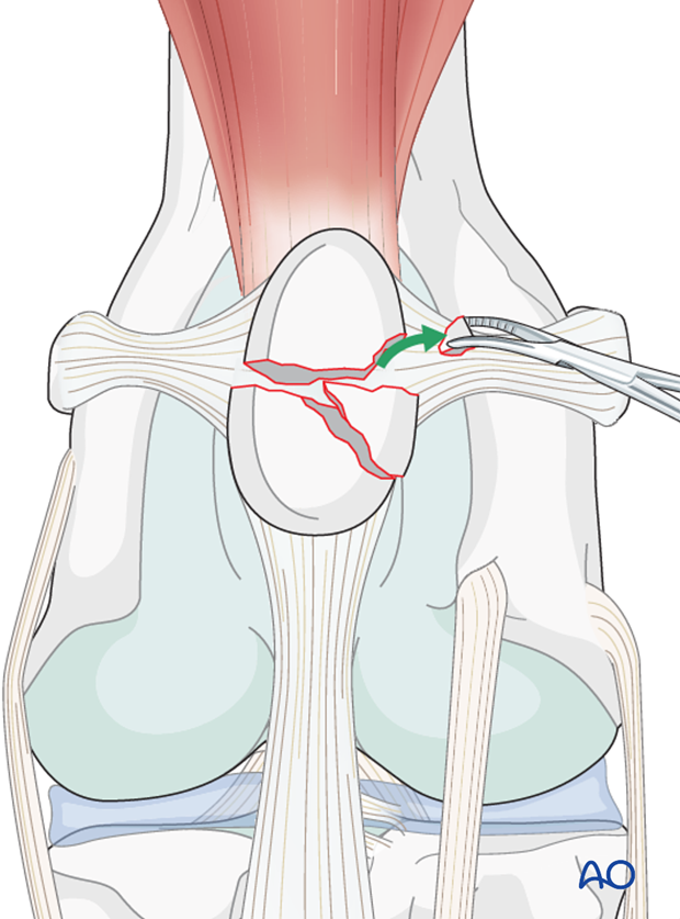 Non-reconstructible fragments removal