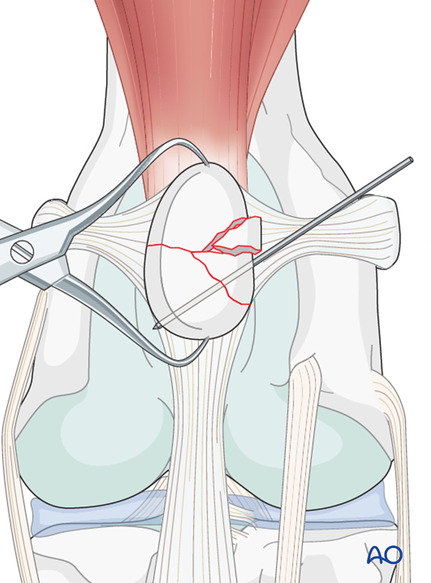 Patellar fragments fixation