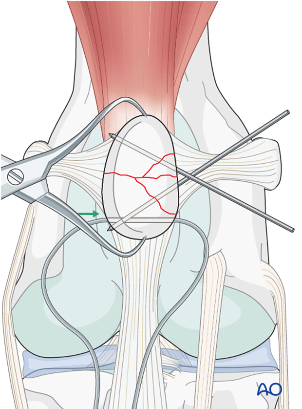 Orthopedic wire pre-placement